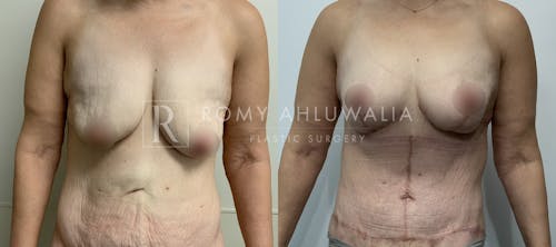 Before & After Result of Breast Reduction Patient #54