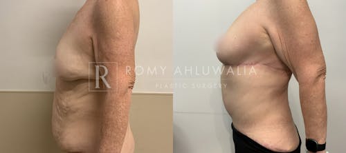 Before & After Result of Breast Reduction Patient #54