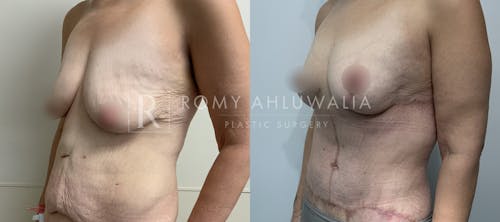 Before & After Result of Breast Reduction Patient #55