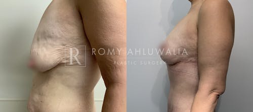 Before & After Result of Breast Reduction Patient #55
