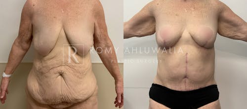 Before & After Result of Breast Reduction Patient #55