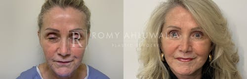 Before & After Result of Facelift Patient #1