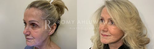 Before & After Result of Facelift Patient #1