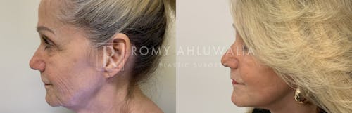 Before & After Result of Facelift Patient #1