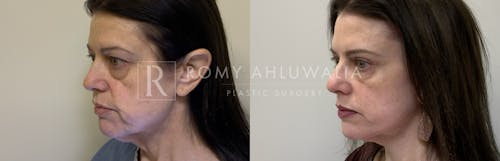 Before & After Result of Brow Lift Patient #1