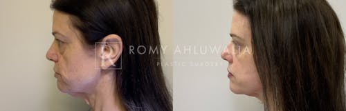 Before & After Result of Brow Lift Patient #1