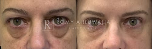 Before & After Result of Upper Eyelid Surgery Patient #21