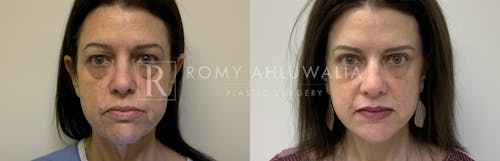 Before & After Result of Mini Facelift with Nanofat Grafting Patient #1