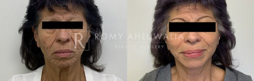 Before & After Result of Mini Facelift with Nanofat Grafting Patient #2