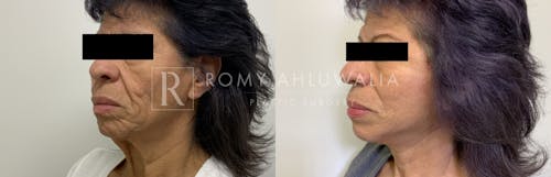 Before & After Result of Mini Facelift with Nanofat Grafting Patient #2