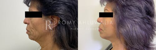 Before & After Result of Mini Facelift with Nanofat Grafting Patient #2