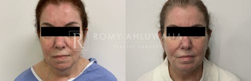 Before & After Result of Mini Facelift with Nanofat Grafting Patient #3