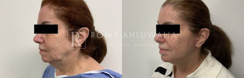 Before & After Result of Mini Facelift with Nanofat Grafting Patient #3