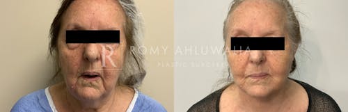 Before & After Result of Mini Facelift with Nanofat Grafting Patient #4