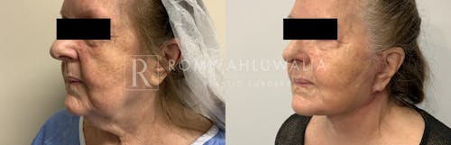 Before & After Result of Mini Facelift with Nanofat Grafting Patient #4