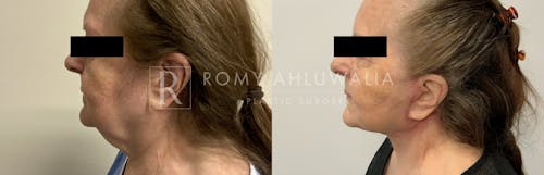 Before & After Result of Mini Facelift with Nanofat Grafting Patient #4