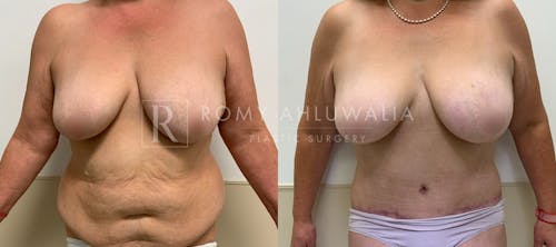 Before & After Result of Tummy Tuck Patient #107