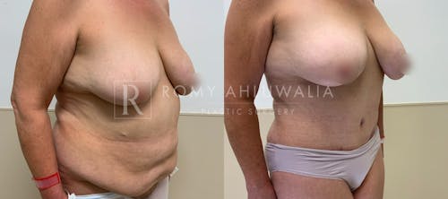 Before & After Result of Tummy Tuck Patient #107