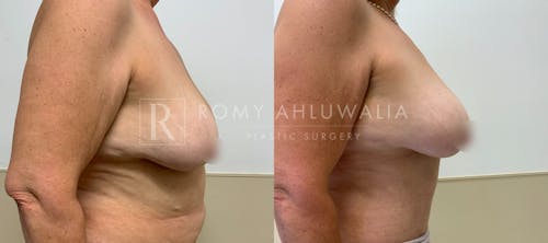Before & After Result of Tummy Tuck Patient #107