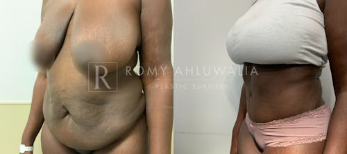 Before & After Result of Tummy Tuck Patient #108