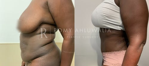 Before & After Result of Tummy Tuck Patient #108
