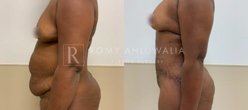 Before & After Result of Tummy Tuck Patient #109