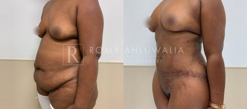 Before & After Result of Tummy Tuck Patient #109
