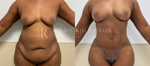 Before & After Result of Tummy Tuck Patient #109