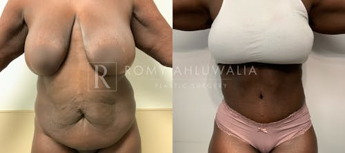 Before & After Result of Tummy Tuck Patient #108