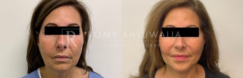 Before & After Result of Mini Facelift with Nanofat Grafting Patient #5