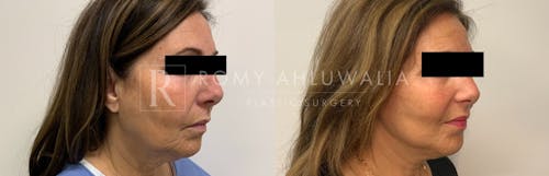 Before & After Result of Mini Facelift with Nanofat Grafting Patient #5