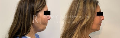 Before & After Result of Mini Facelift with Nanofat Grafting Patient #5