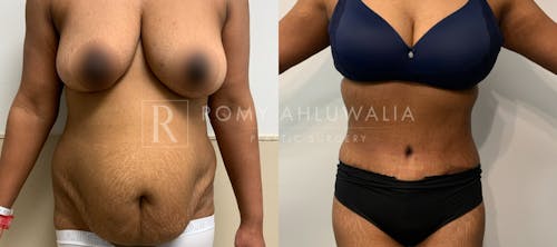 Before & After Result of Tummy Tuck Patient #6