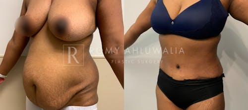 Before & After Result of Tummy Tuck Patient #6