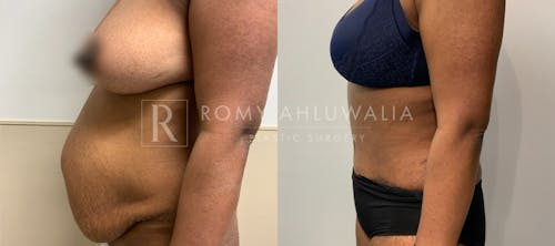 Before & After Result of Tummy Tuck Patient #6