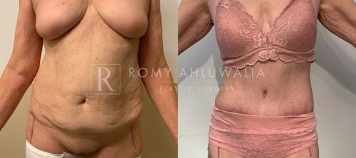 Before & After Result of Tummy Tuck Patient #110