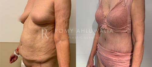Before & After Result of Tummy Tuck Patient #110