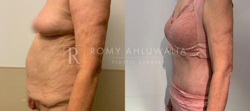 Before & After Result of Tummy Tuck Patient #110