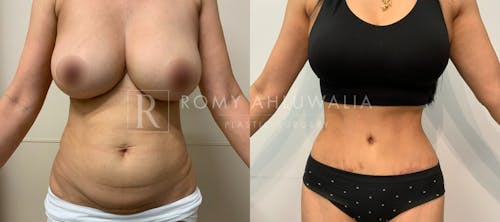 Before & After Result of Tummy Tuck Patient #1