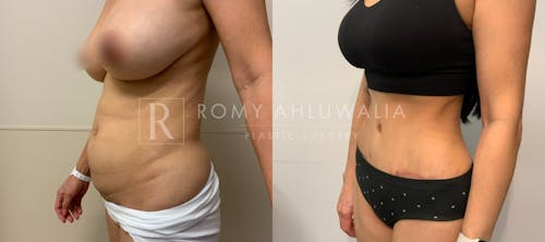 Before & After Result of Tummy Tuck Patient #1