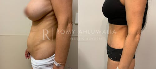 Before & After Result of Tummy Tuck Patient #1