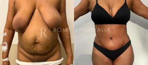 Before & After Result of Tummy Tuck Patient #111