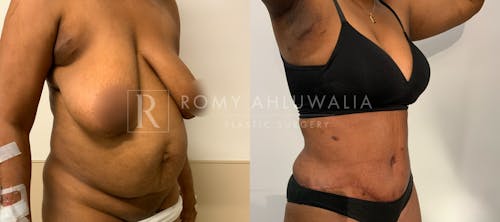 Before & After Result of Tummy Tuck Patient #111
