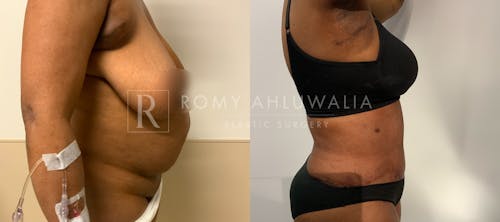 Before & After Result of Tummy Tuck Patient #111