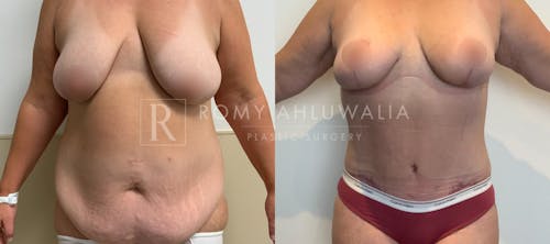 Before & After Result of Tummy Tuck Patient #112