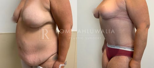 Before & After Result of Tummy Tuck Patient #112