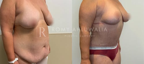 Before & After Result of Tummy Tuck Patient #112