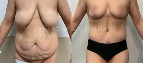 Before & After Result of Tummy Tuck Patient #113