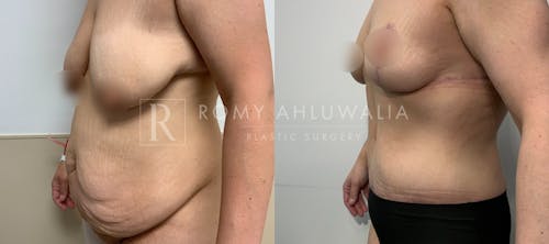 Before & After Result of Tummy Tuck Patient #113