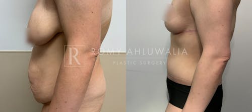 Before & After Result of Tummy Tuck Patient #113